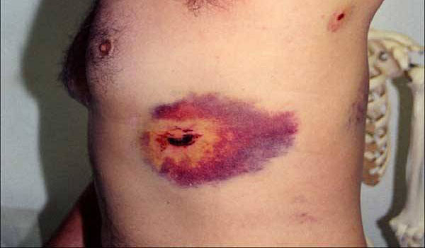 bruise.jpeg