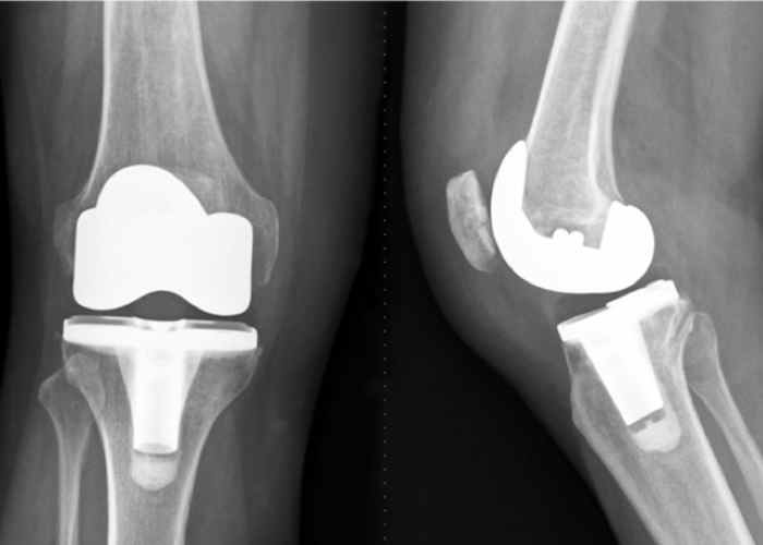 x-ray-after-total-knee-replacement-fi.jpg