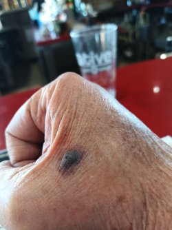 hammer bite.jpg