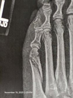 sep 20205 broken foot (6).jpg