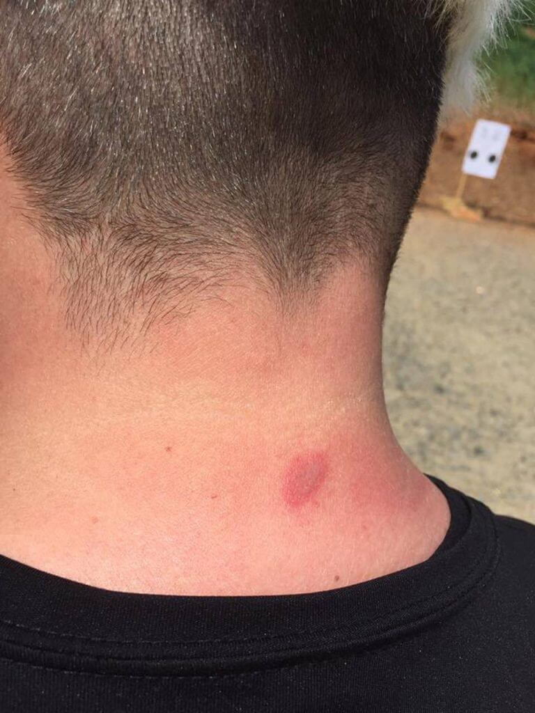 neck injury from hot brass neck injury from hot brass