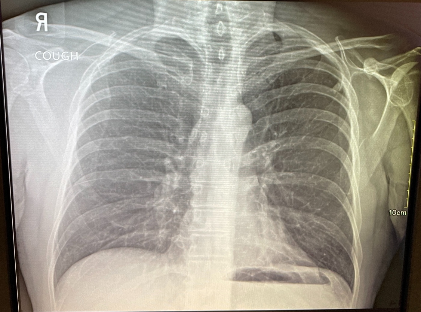 In this photograph, we see an x-ray of chest cavity. The dark areas are empty air sacs.